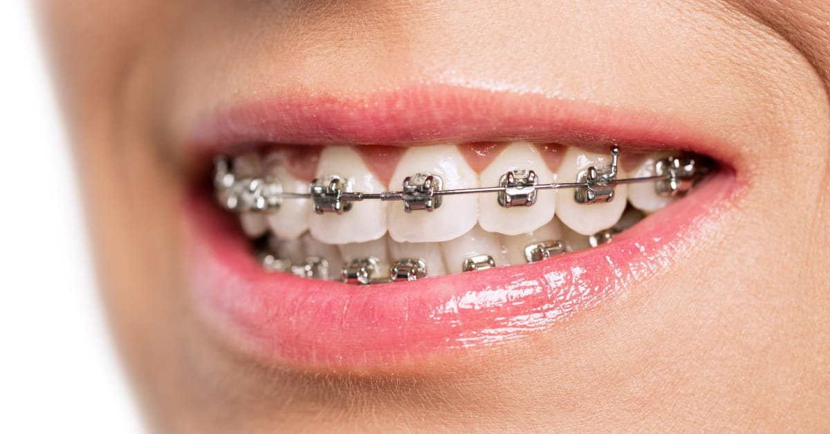 How to Remove Braces in Photoshop?