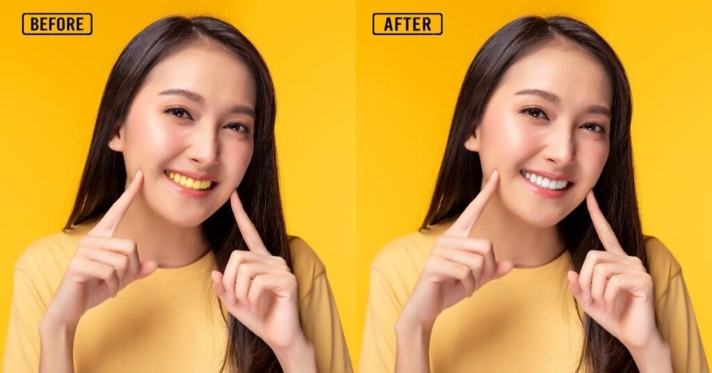 Teeth Whitening in Fashion Photos