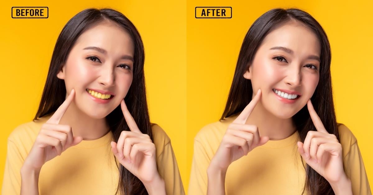 Teeth Whitening in Fashion Photos